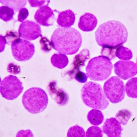Leukaemia-Care_5